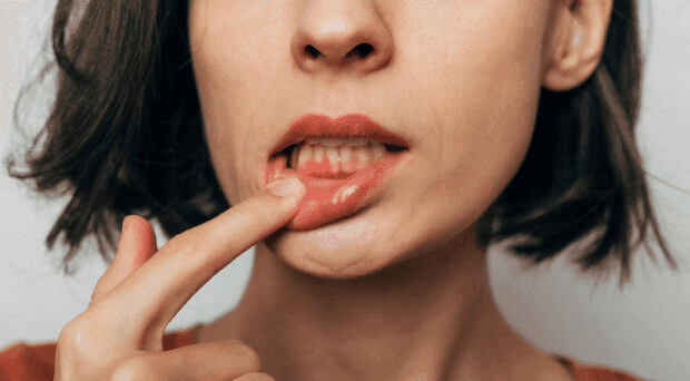 oral mucositis condition image