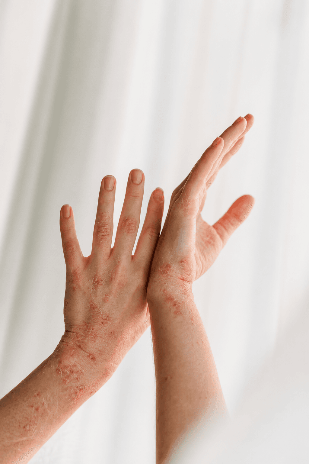 Hands with eczema reaching out.