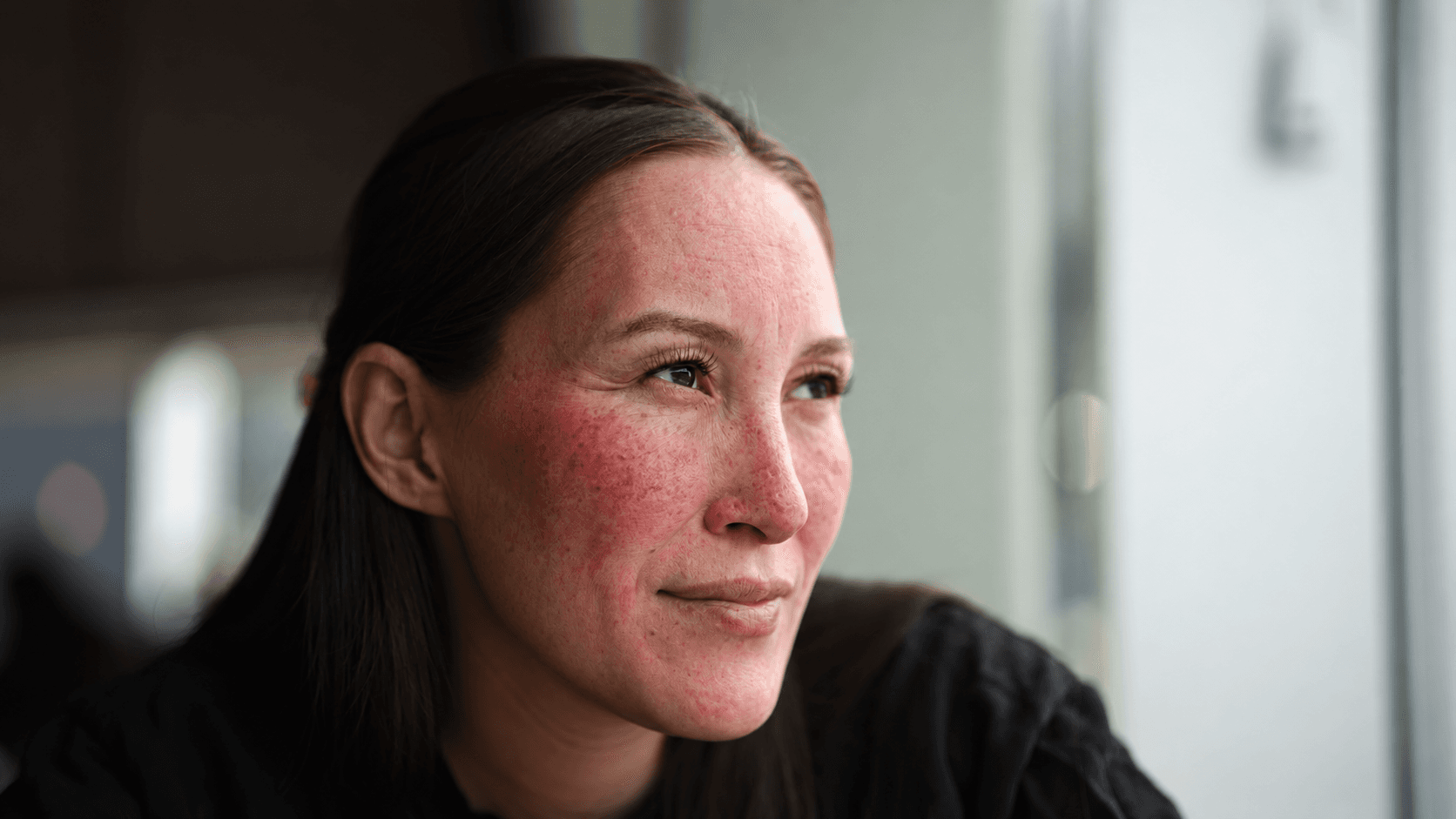 Woman with rosacea looking out of window.