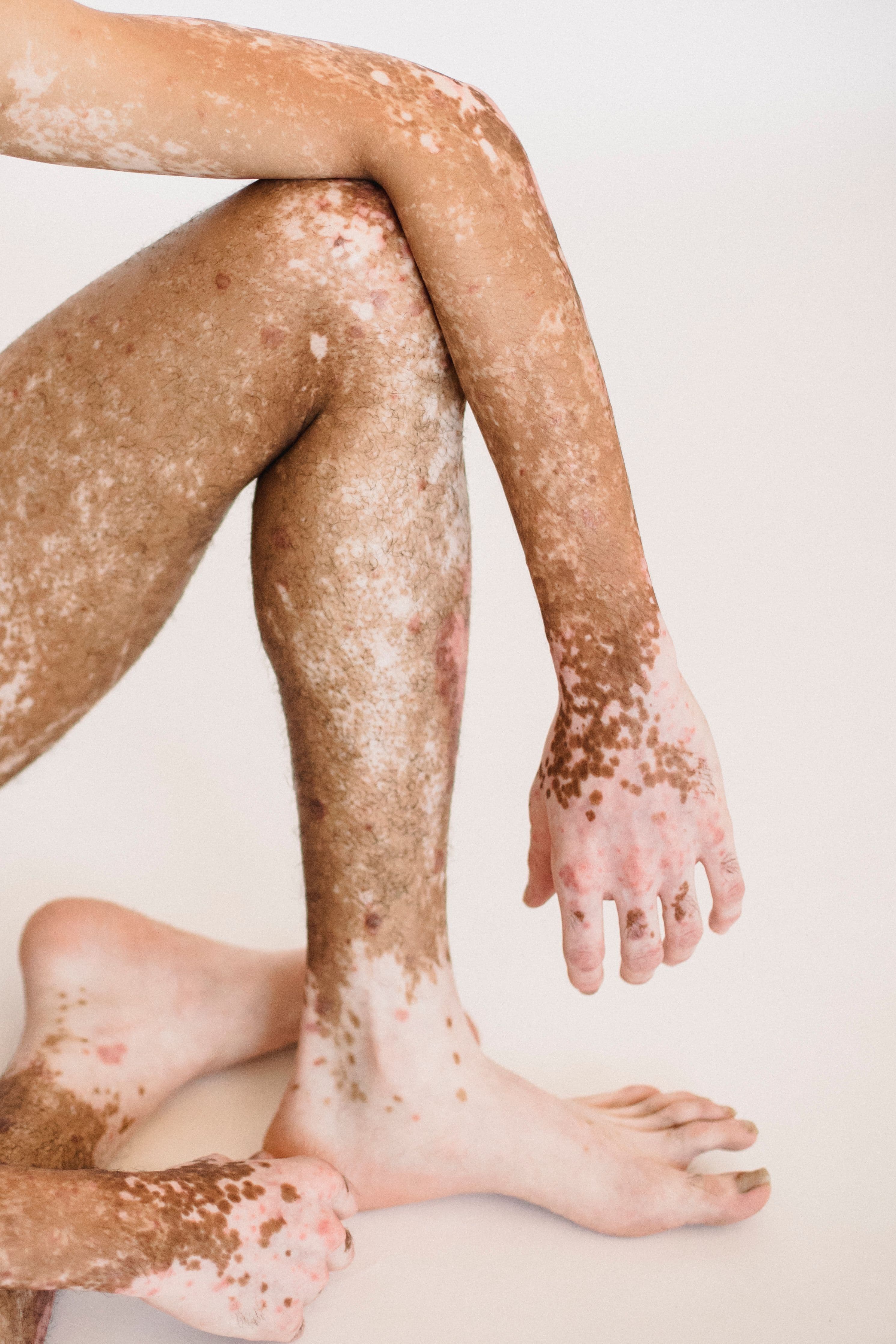 Arms and legs of a person with vitiligo.