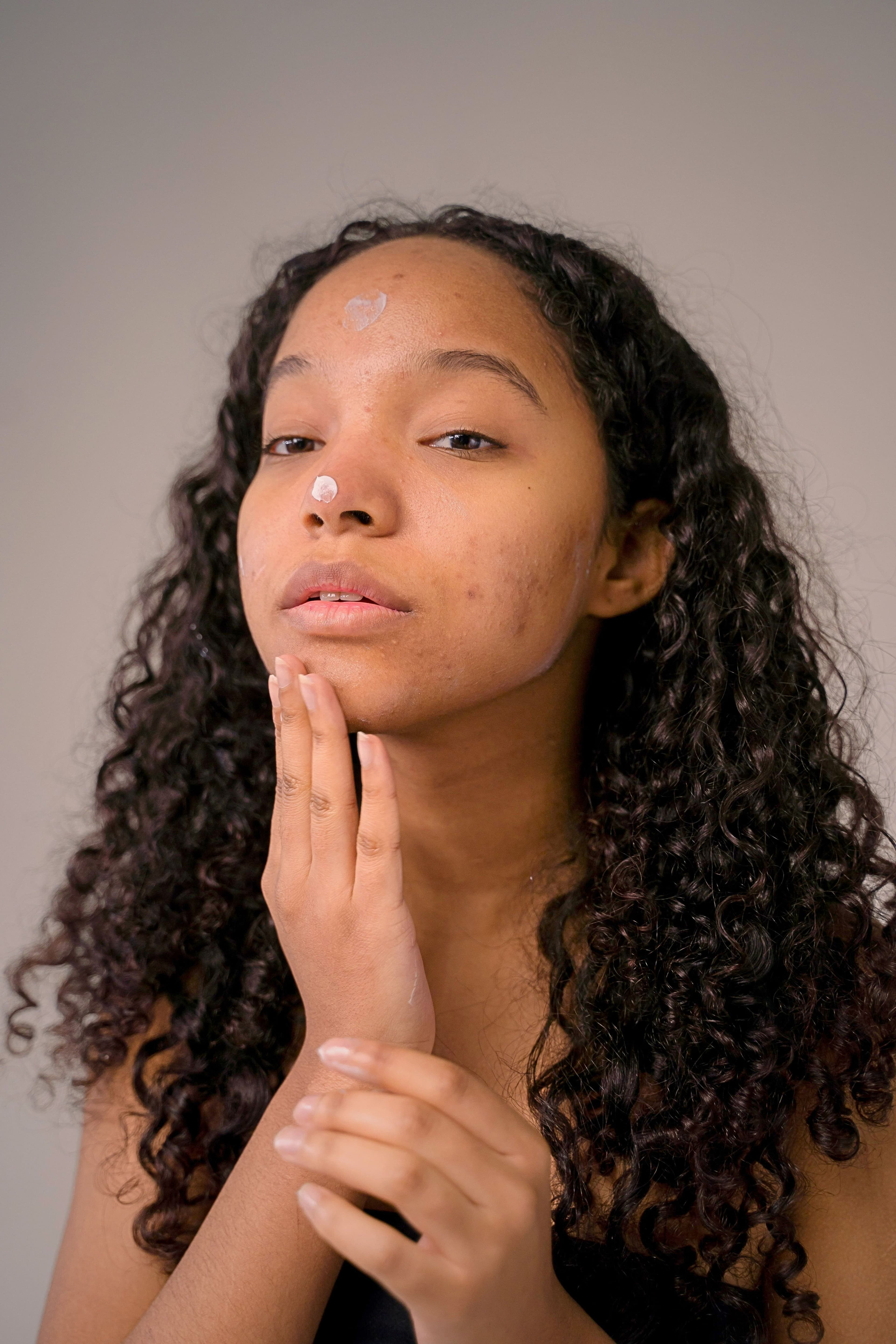 Woman with acne scars touching her face.